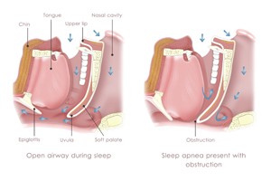 Obstructive Sleep Apnea